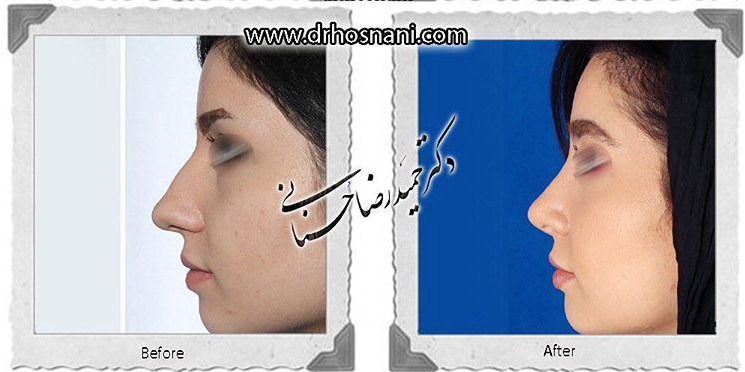 اصلاح انحراف بینی