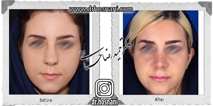 اصلاح انحراف بینی