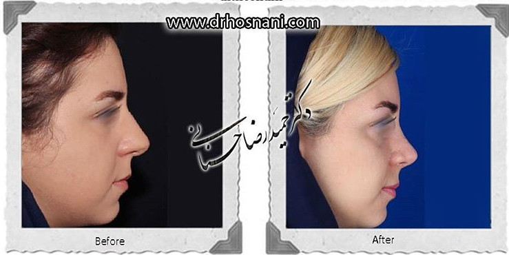 اصلاح انحراف بینی