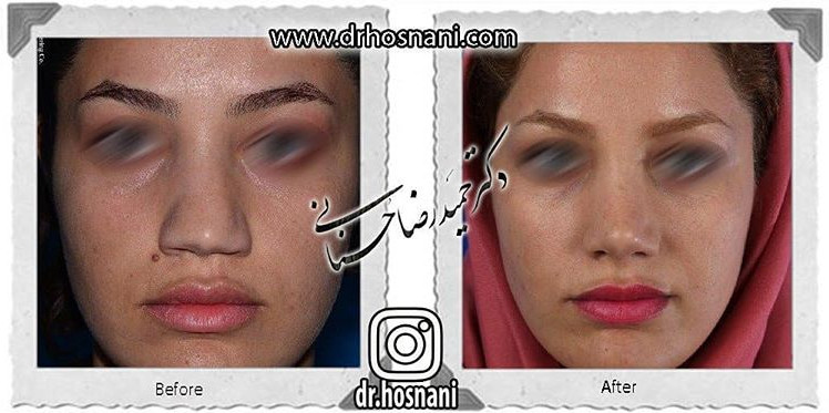 اصلاح انحراف بینی