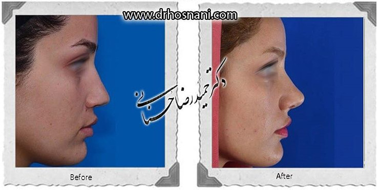 اصلاح انحراف بینی