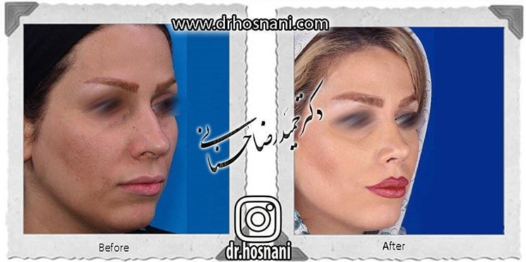  جراحی بینی -722