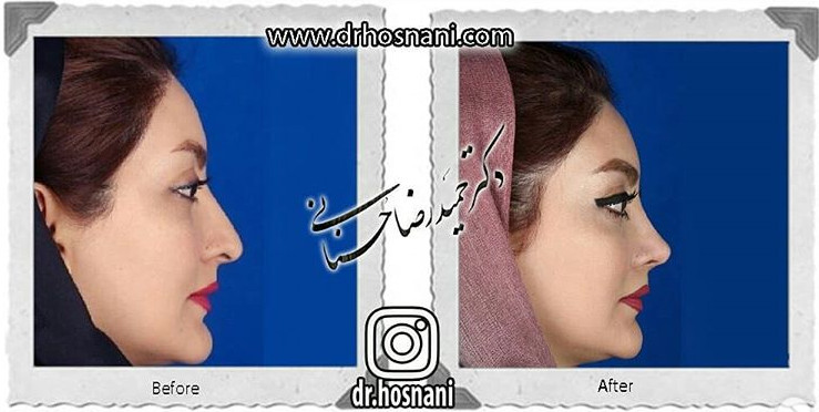 جراحی بینی -725