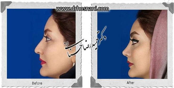  جراحی بینی -726