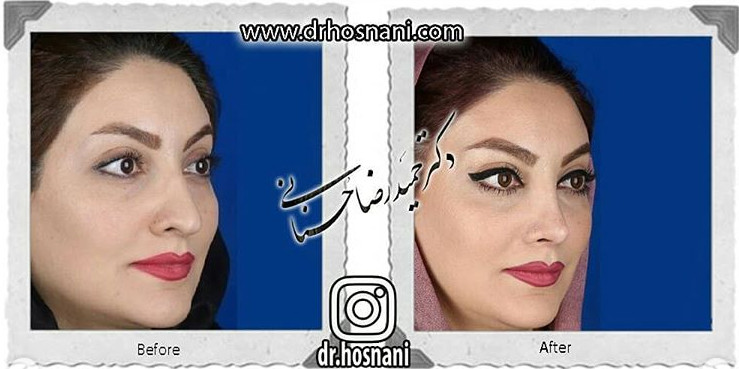  جراحی بینی -727