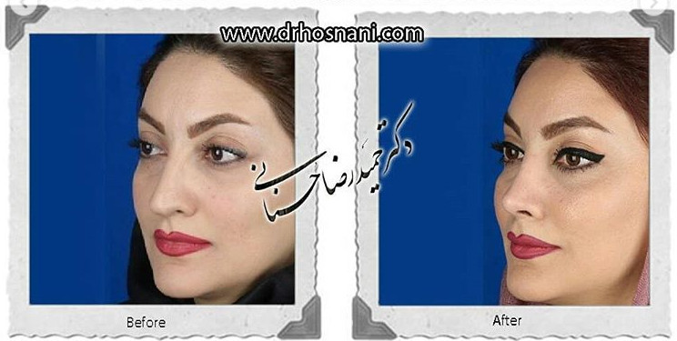  جراحی بینی -728