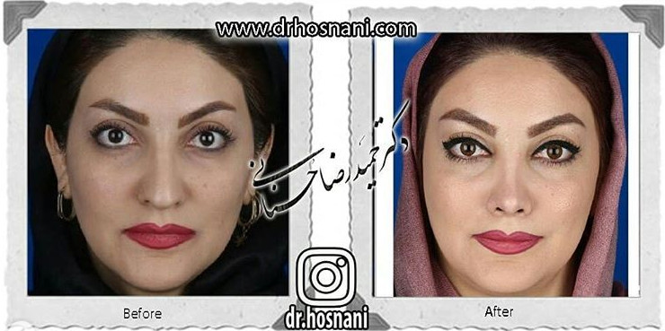  جراحی بینی -729