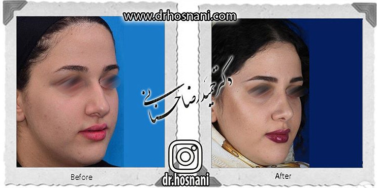  جراحی بینی -731