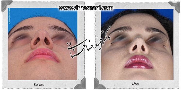  جراحی بینی -732