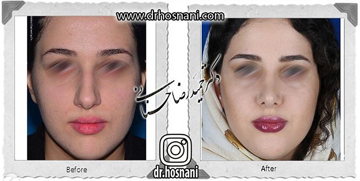  جراحی بینی -733