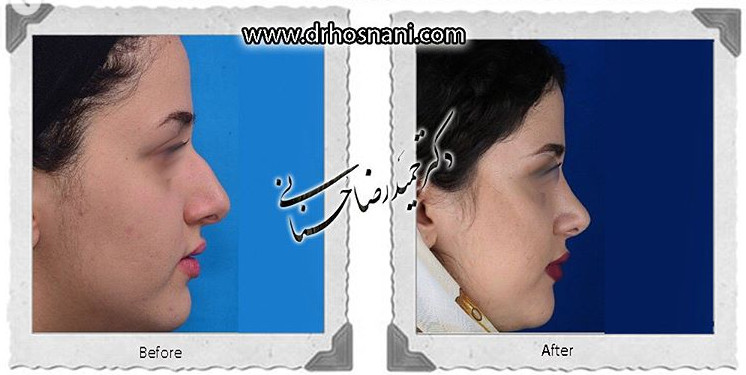  جراحی بینی -734