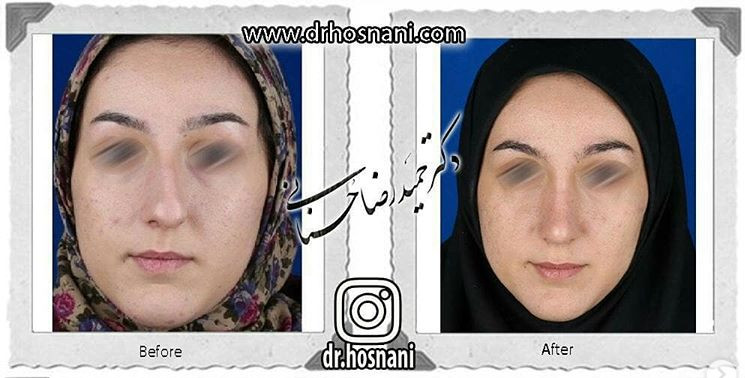 اصلاح انحراف بینی