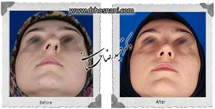 اصلاح انحراف بینی