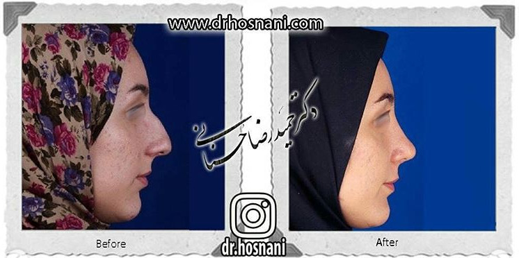 اصلاح انحراف بینی