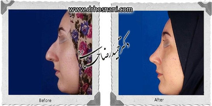 اصلاح انحراف بینی