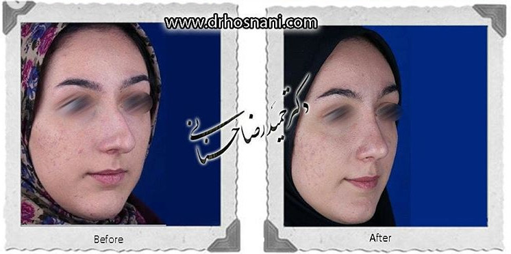 اصلاح انحراف بینی