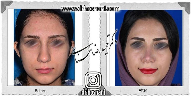  جراحی بینی -741