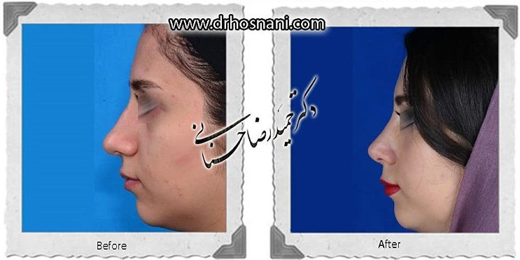 جراحی بینی -742