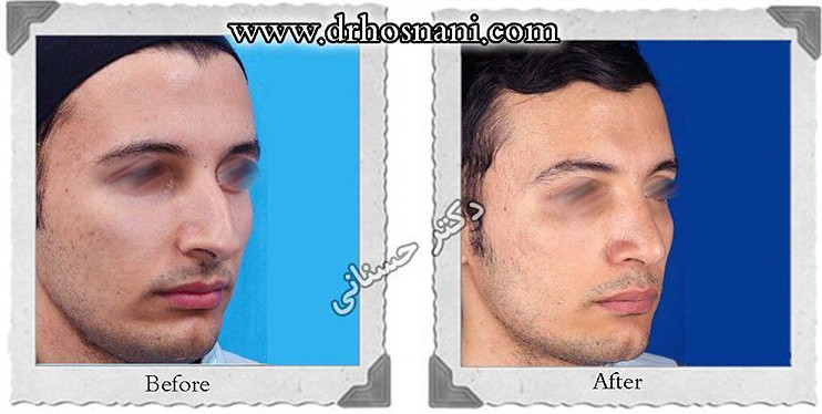  جراحی بینی -743