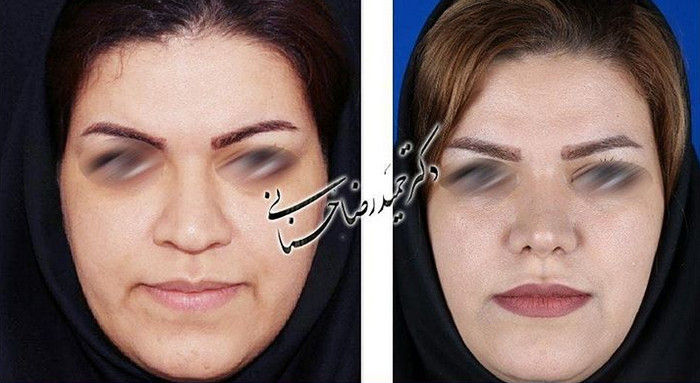  جراحی بینی -745