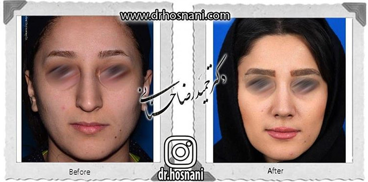  جراحی بینی -746