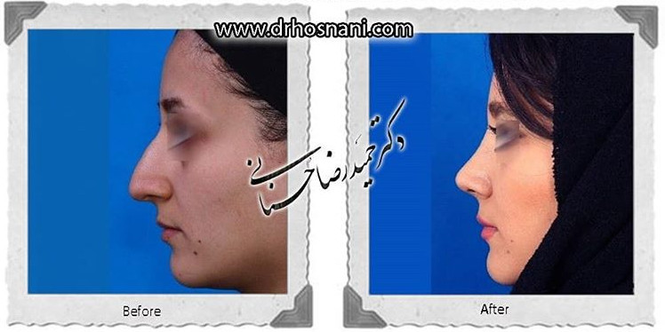  جراحی بینی -747