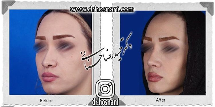  جراحی بینی -748