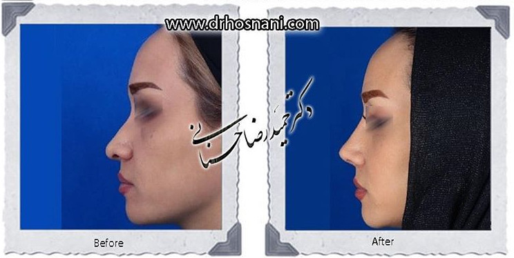  جراحی بینی -749