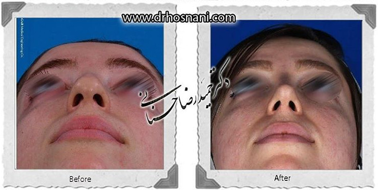  جراحی بینی -751