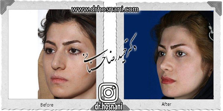  جراحی بینی -752