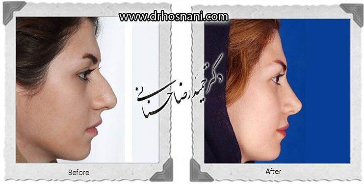  جراحی بینی -753