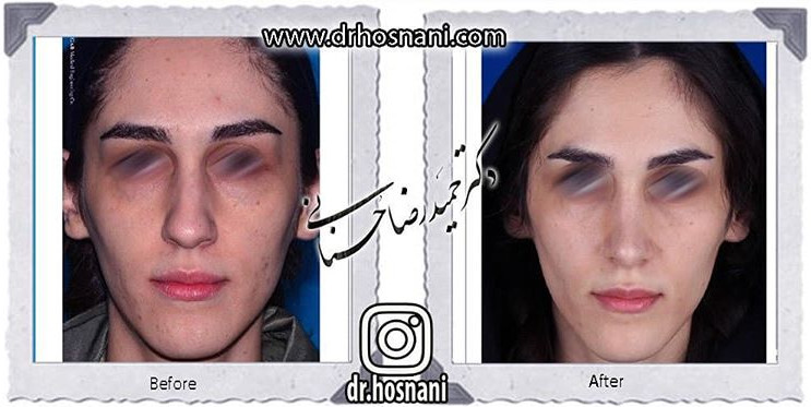 اصلاح انحراف بینی