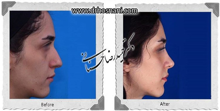 اصلاح انحراف بینی