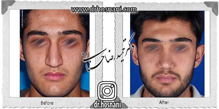 اصلاح انحراف بینی