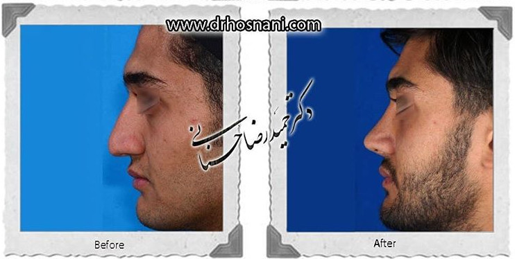 اصلاح انحراف بینی