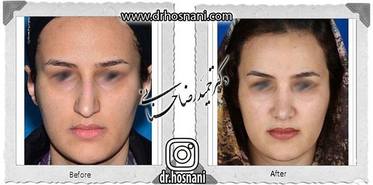 اصلاح انحراف بینی