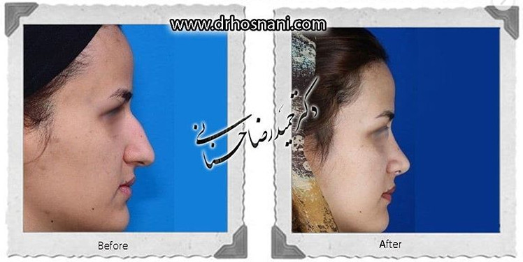 اصلاح انحراف بینی