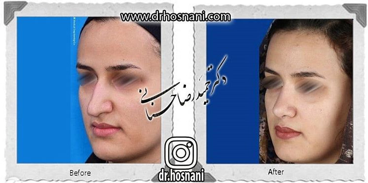 اصلاح انحراف بینی