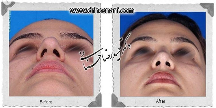 اصلاح انحراف بینی