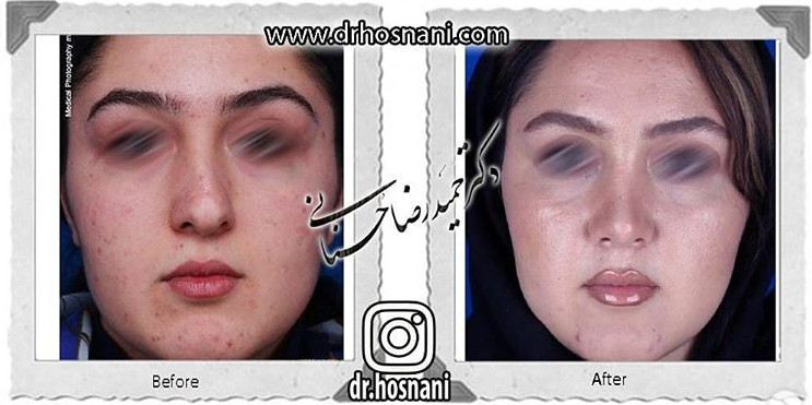 اصلاح انحراف بینی