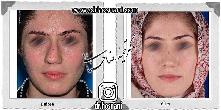 اصلاح انحراف بینی