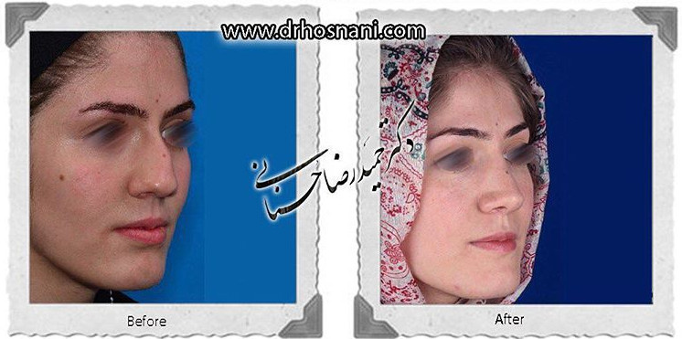 اصلاح انحراف بینی