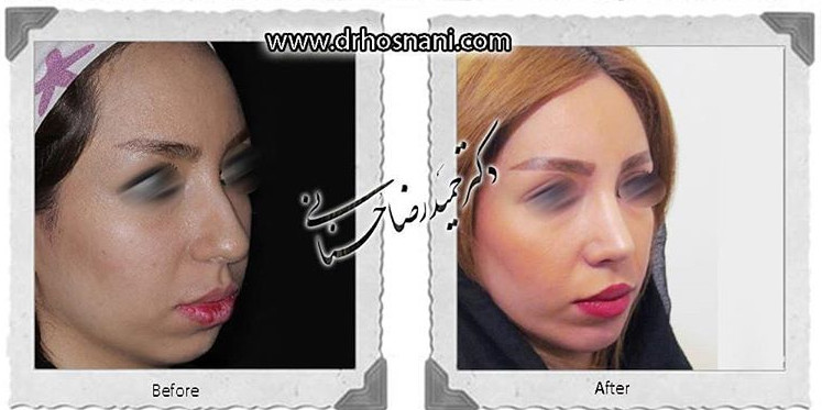  جراحی بینی -767