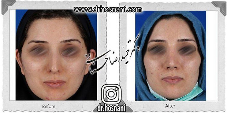  جراحی بینی -768
