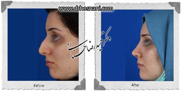  جراحی بینی -769