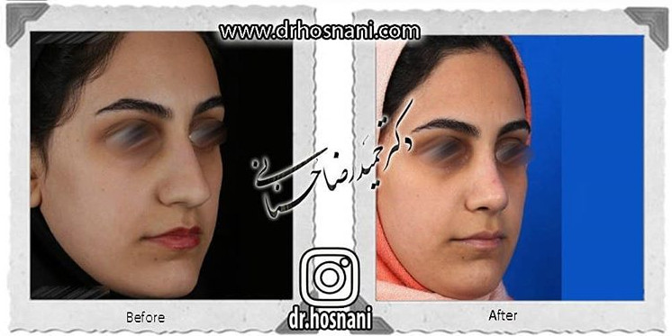  جراحی بینی -770