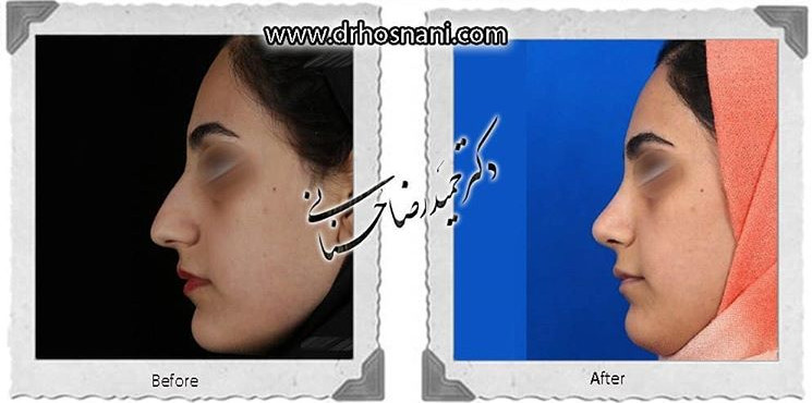 جراحی بینی -771
