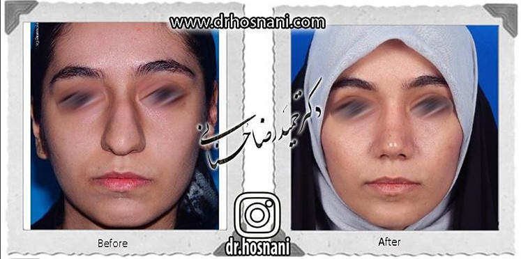 اصلاح انحراف بینی
