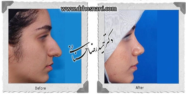 اصلاح انحراف بینی