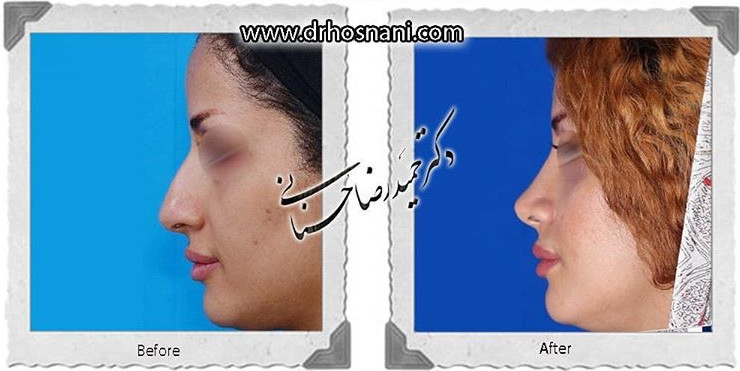  جراحی بینی -775